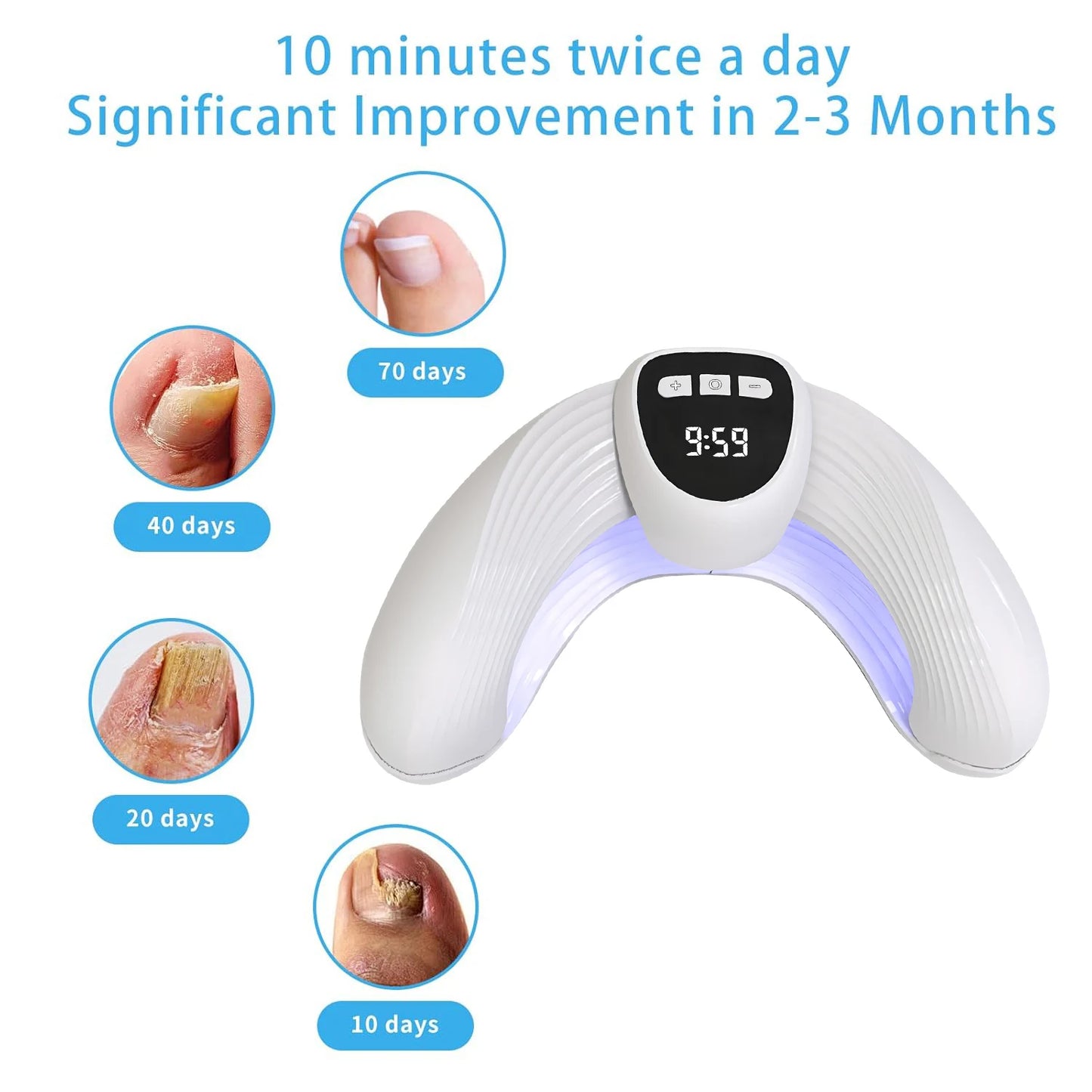 MycoBeam Nail Fungus Laser – Home Use