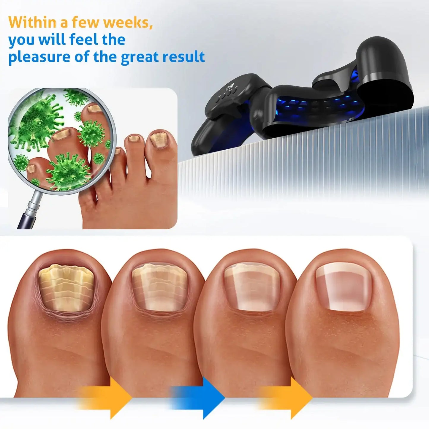 MycoBeam Wireless Nail Laser – Dual 470/905 nm