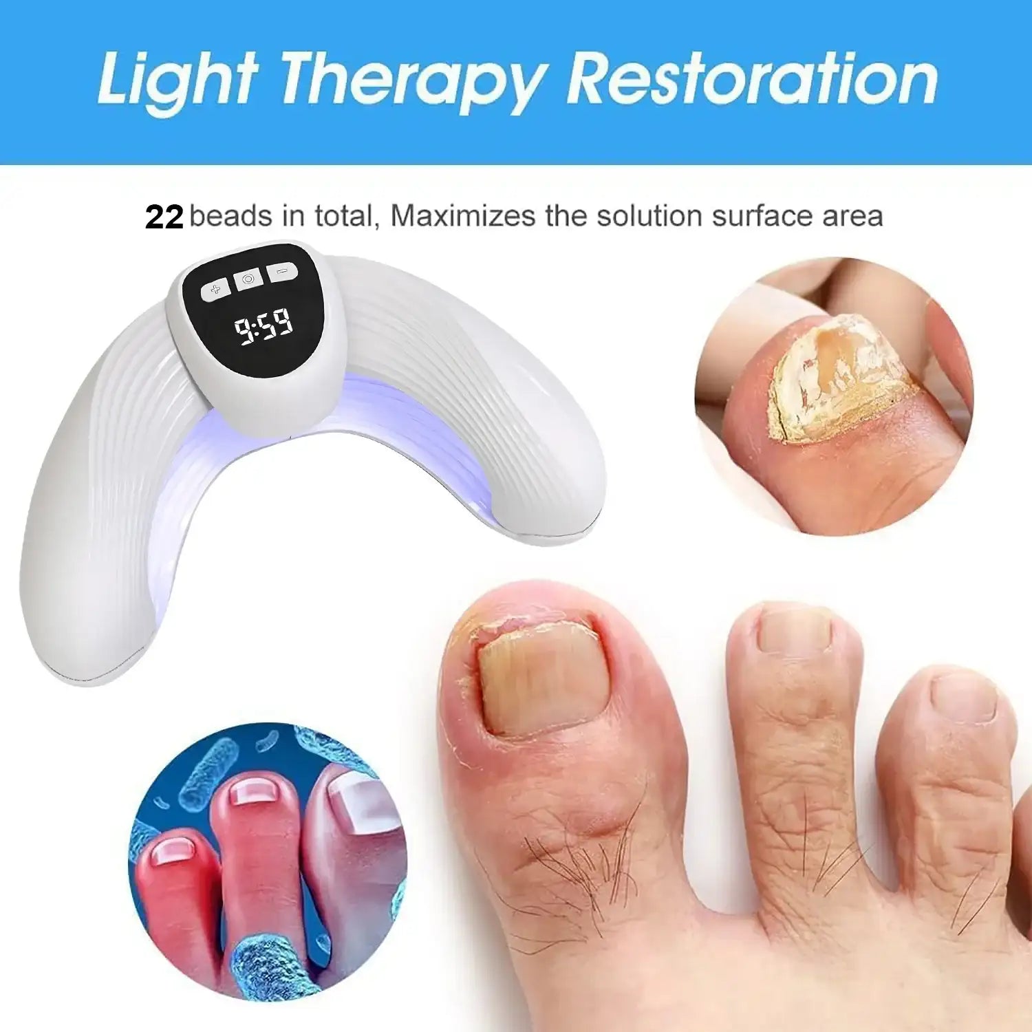 MycoBeam Nail Fungus Laser – Home Use