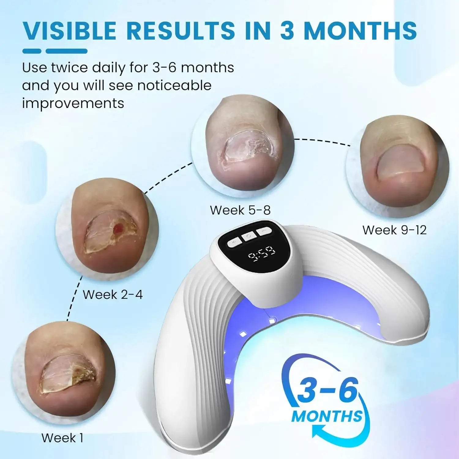 MycoBeam Nail Fungus Laser – Home Use