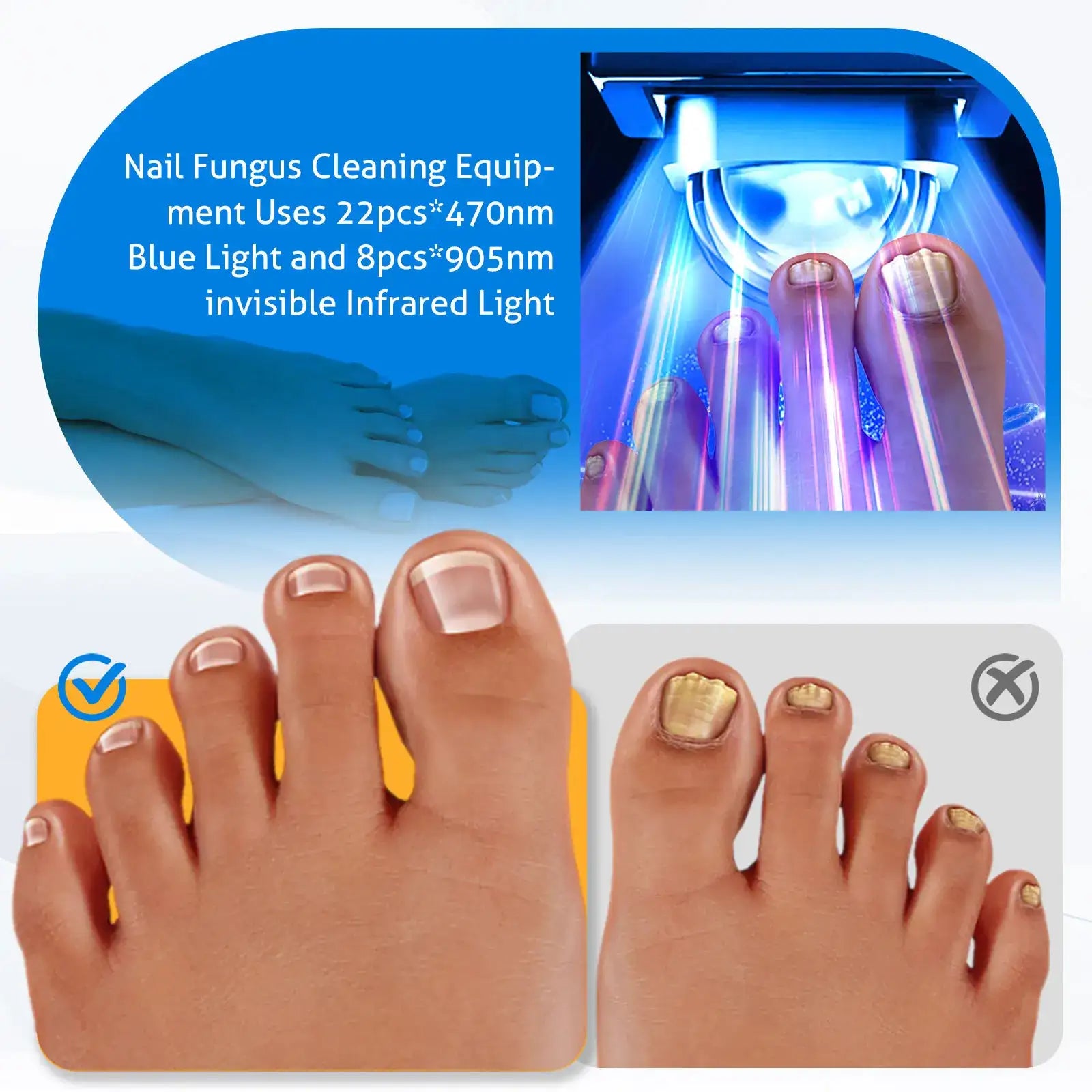 MycoBeam Wireless Nail Laser – Dual 470/905 nm