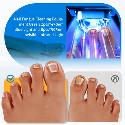 MycoBeam Wireless Nail Laser – Dual 470/905 nm