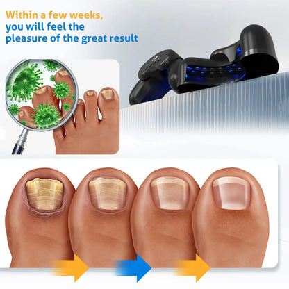 MycoBeam Wireless Nail Laser – Dual 470/905 nm