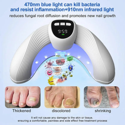 MycoBeam Nail Fungus Laser – Home Use